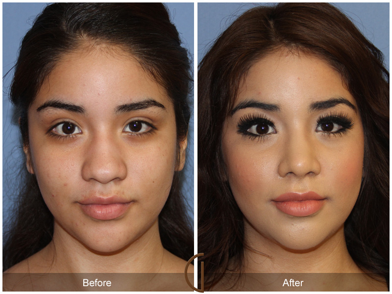 Top FAQs About South Indian/Ethnic Rhinoplasty in Bangalore