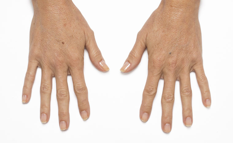 Non-surgical Hand Rejuvenation at Dr. Karishma Aesthetics | Bangalore