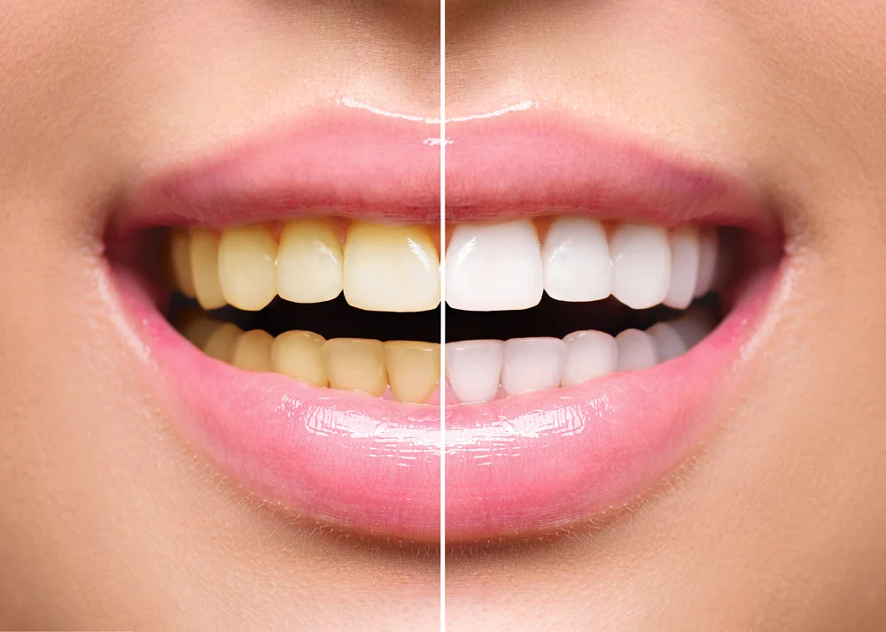 Experience a Whiter and Brighter Smile at Dr Karishma Aesthetics: Best Teeth Whitening Treatment in Bangalore