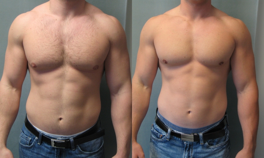 Top 4 Reasons: Why Should You Undergo Male Breast Reduction/ Gynecomastia Surgery?