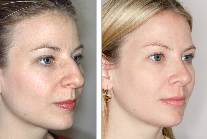 Cosmetic vs. Medical Reasons for a Nose Job | Rhinoplasty Surgery