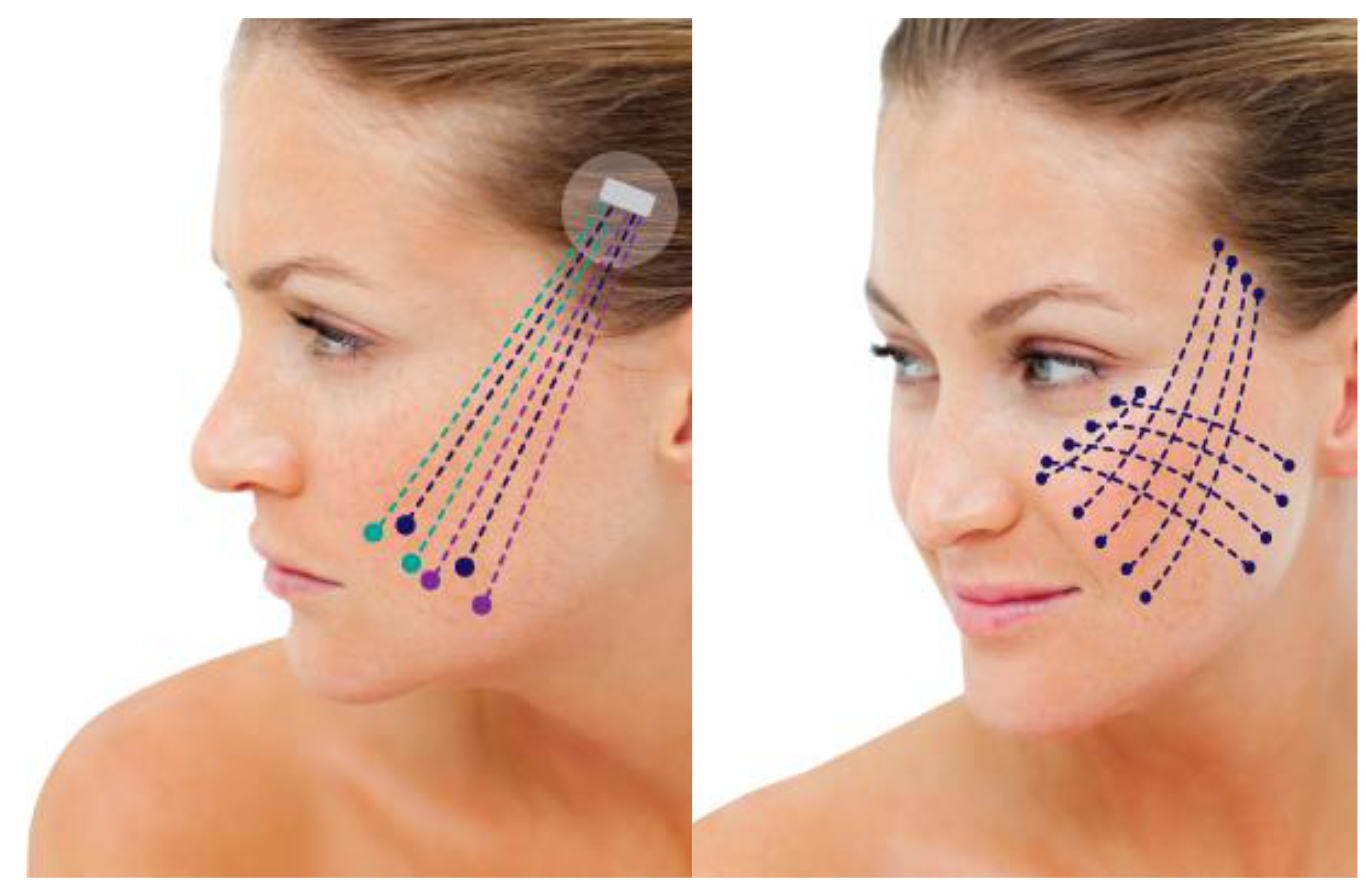 What Should You Know about APTOS Thread lifting: Top 4 Points to Check about