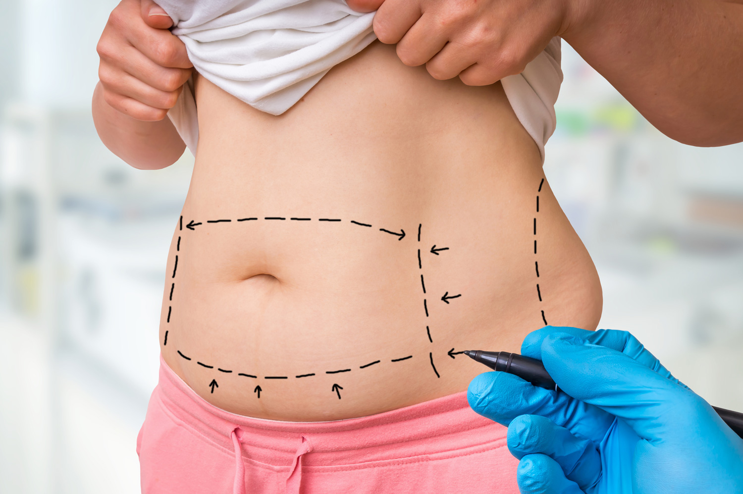 What Post-op Care is Required Following Liposuction Surgery